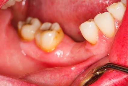 виниры, стоматология, москва, стоматолог, отродонт, брекеты, зубы, пульпит, парадонтит,парадонтоз, лечени зубов, отбеливание зубов, протезирование зубов, импланты, штифт, пломбы, пломбирование, виниринг, здоровье, красота,косметология, красивая углыбка, улыбка, голливудская улыбка 