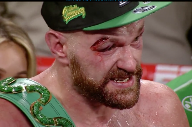 Тайсон Фьюри получил серьезное рассечение в третьем раунде против Отто Валлина (Изображение: ESPN)