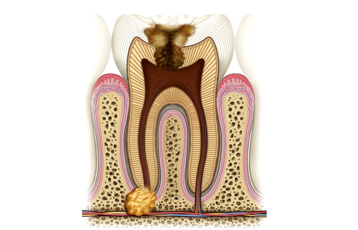 КИСТА ЗУБА - РЕЗУЛЬТАТ НЕ КАЧЕСТВЕННОГО ЛЕЧЕНИЯ КАНАЛОВ ПРИВОДИТ К ПОТЕРЕ ЗУБА В БОЛЬШИНСТВЕ СЛУЧАЕВ.