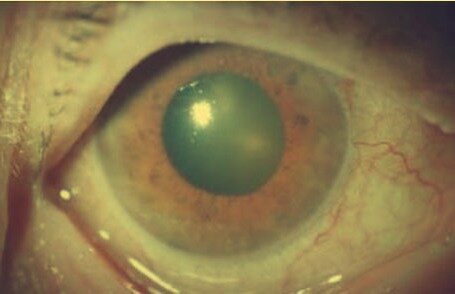 зеленый цвет зрачка при глаукоме