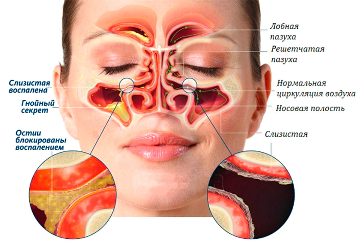 Лор заболевания носа. Гайморовы пазухи гайморит. Носовая пазуха и гайморова пазуха. Носовые пазухи строение гайморит.
