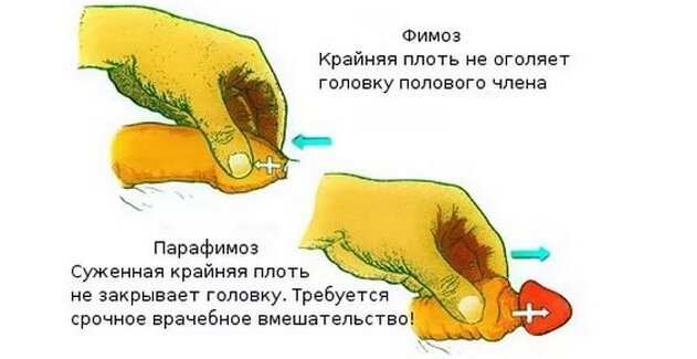 Что такое синехии крайней плоти?