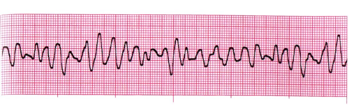Фибриляляция желудочков