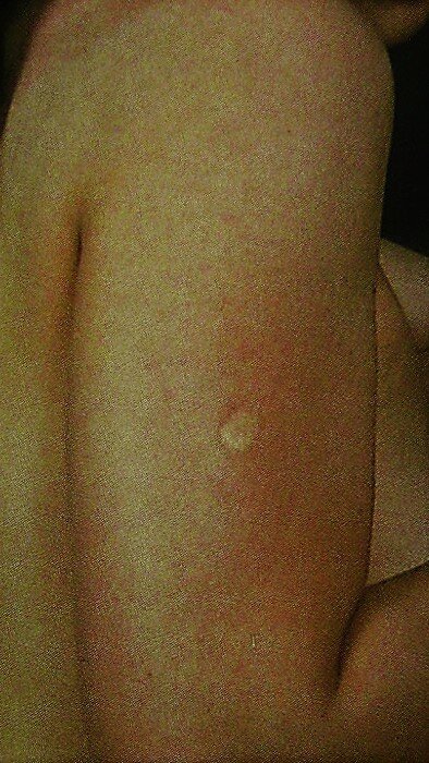 Рубец после вакцинации от натуральной оспы. Автор: シトラマタ - собственная работа, CC BY-SA 4.0, https://commons.wikimedia.org/w/index.php?curid=69046229