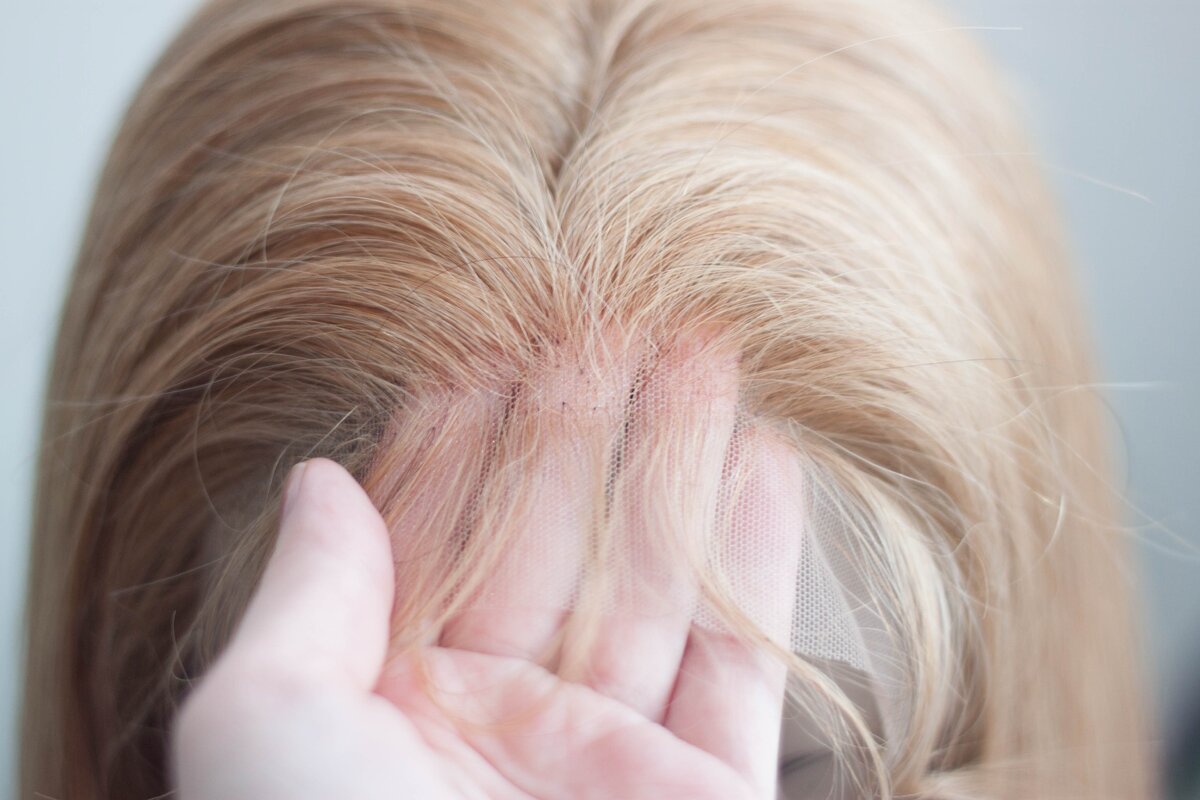 Система замещения волос на сетке. Фото yandex.ru