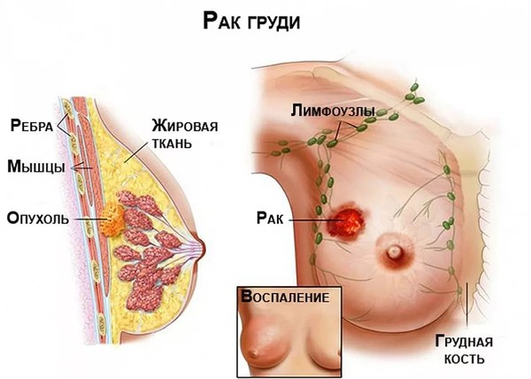 Лечение рака «народными средствами»