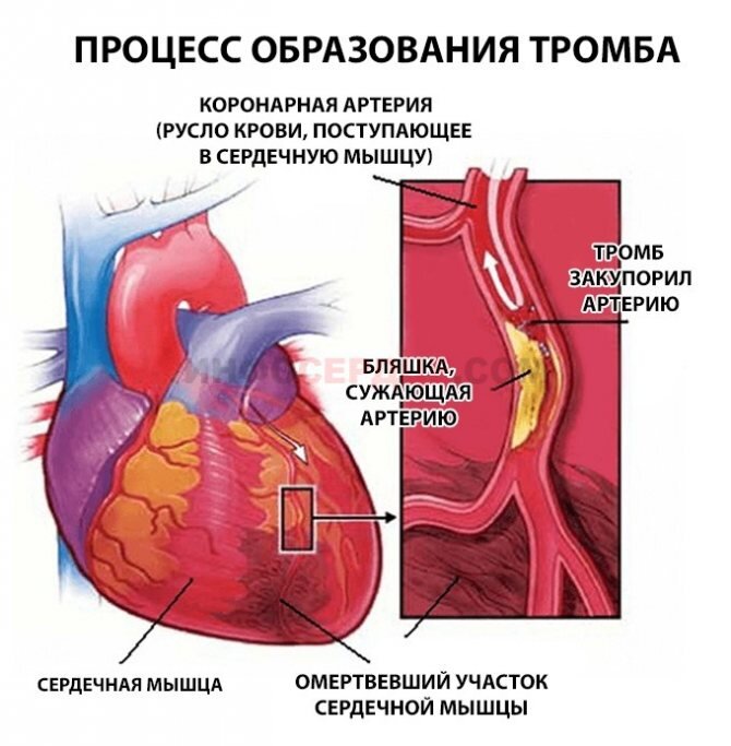 Признаки и симптомы тромбоза глубоких вен