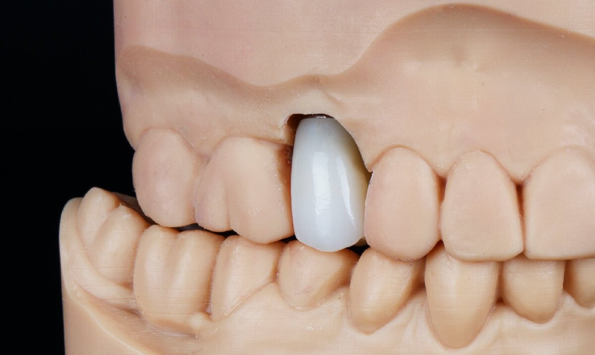 Зубные коронки на имплантах: как ставят и какие лучше?