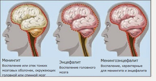 Лечение хронической ишемии мозга в Житомире