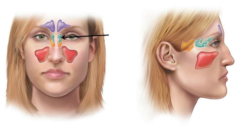 Болят пазухи носа. Гайморит фронтит этмоидит. Сфеноидальный синусит. Синусит фронтит этмоидит сфеноидит.