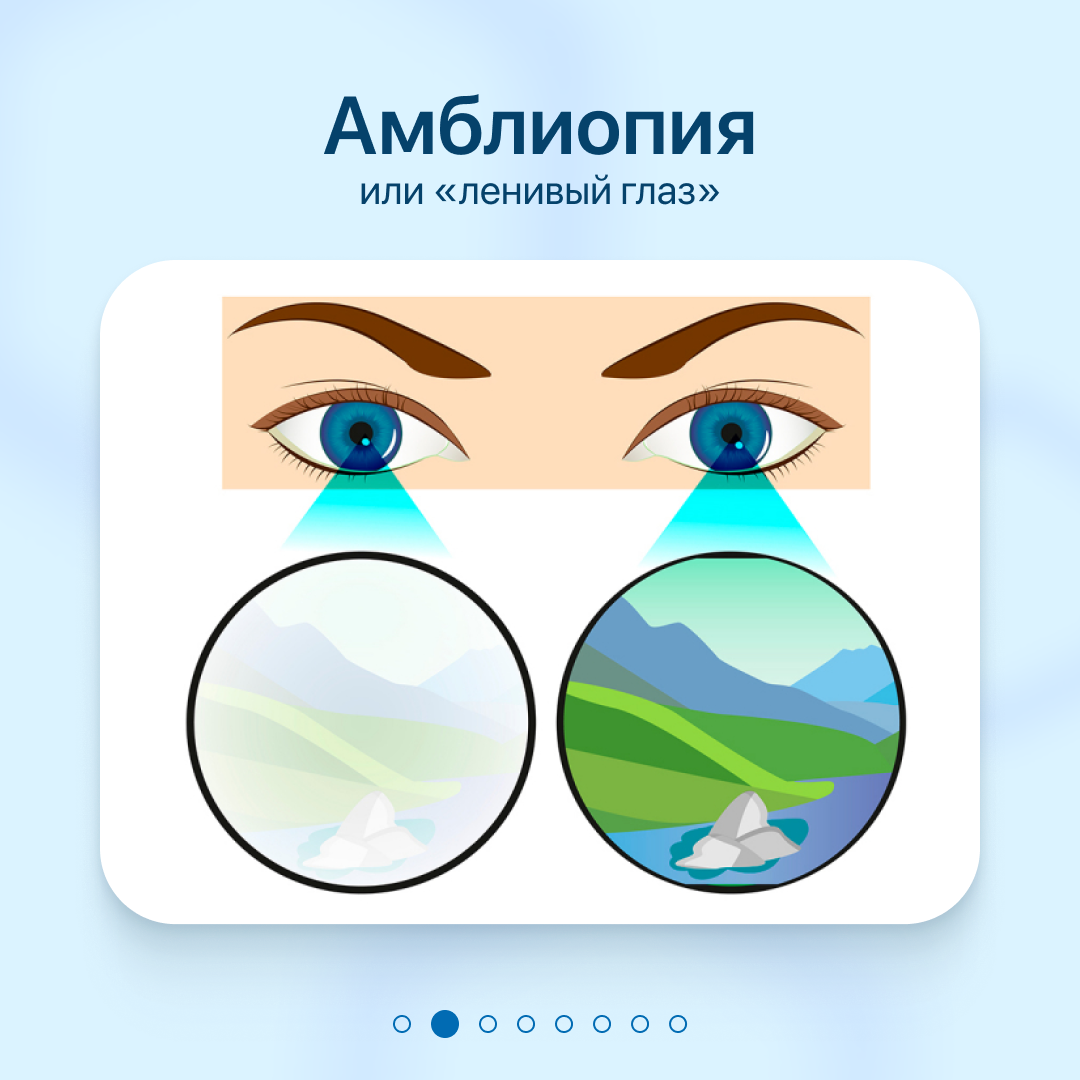 Амблиопия. Синдром ленивого глаза у взрослых. Синдром ленивого глаза у взрослых. Небольшое косоглазие. Амблиопия.