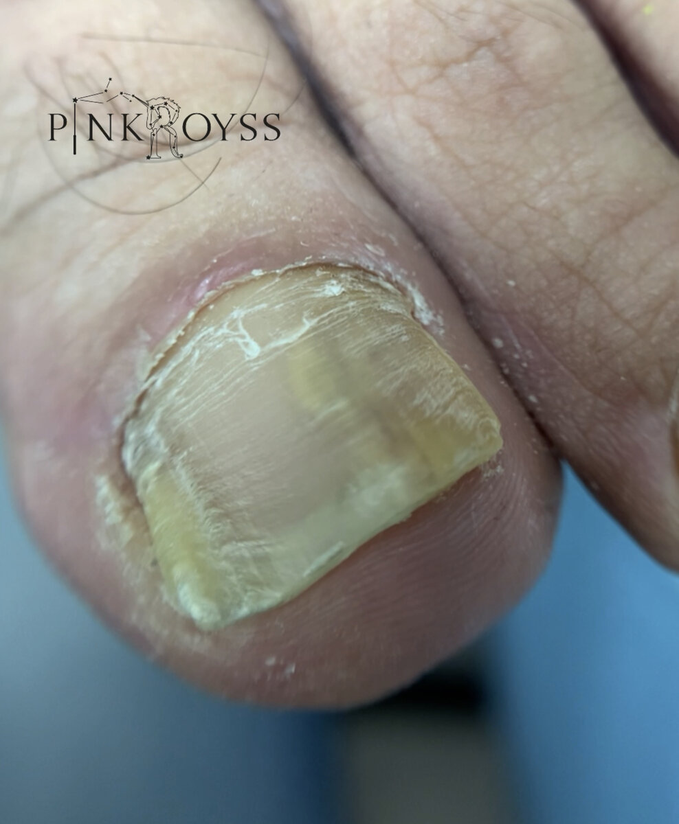 Признаки онихолизиса ногтей
