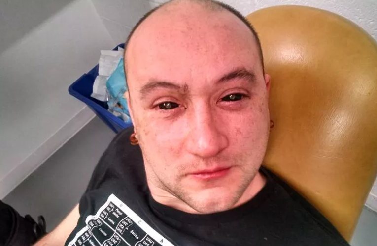 После инъекции  Ce-6 в глаза