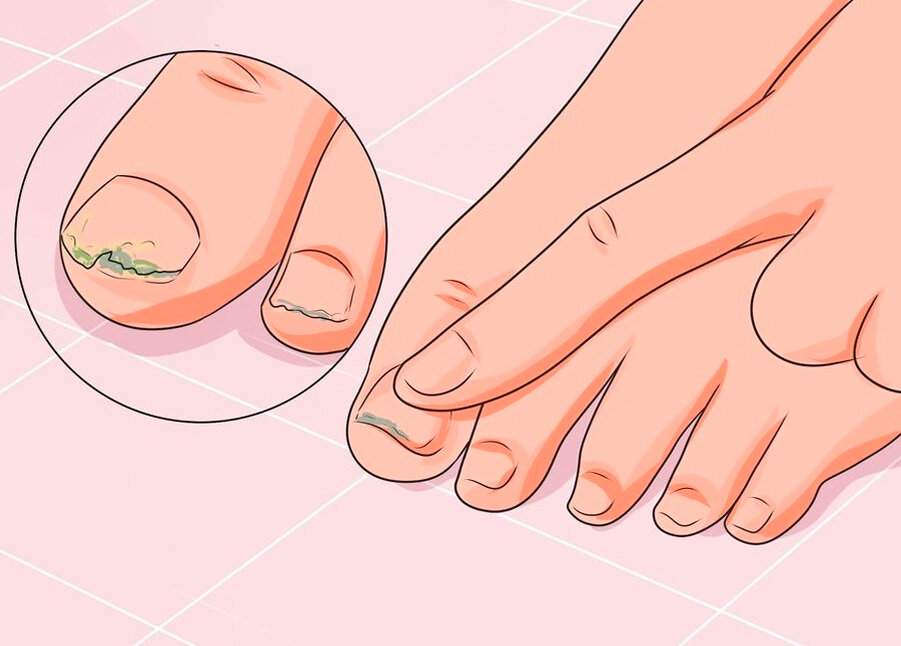 Грибок ногтей на ногах: что это, причины, сколько стоит лечение, лекарства от онихомикоза
