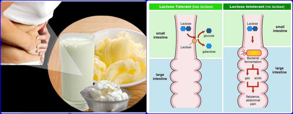 Стул при непереносимости лактозы