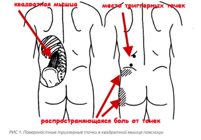 Боль поясница слева отдает в ногу. Боль в пояснице слева. Болит поясница слева. Болит спина. Боль в поясничной области слева.