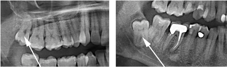 Обязательно ли удалять зубы. Ретинированный зуб мудрости рентген. Снимок зуба мудрости снизу. Анкилоз ретинированного зуба.