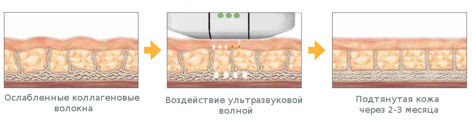 Механизм воздействия аппарата Альтера.