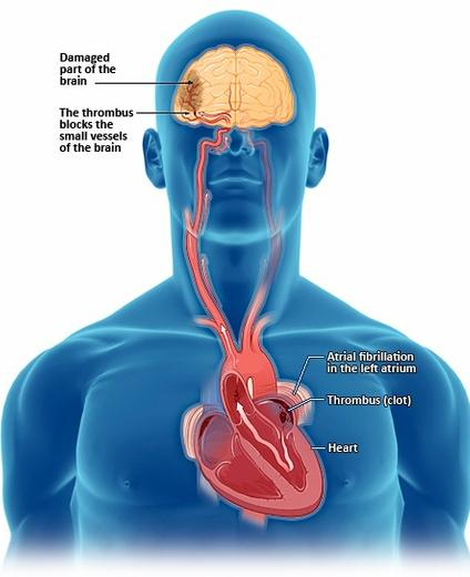 Аритмия сердца – что это такое, и как лечить?