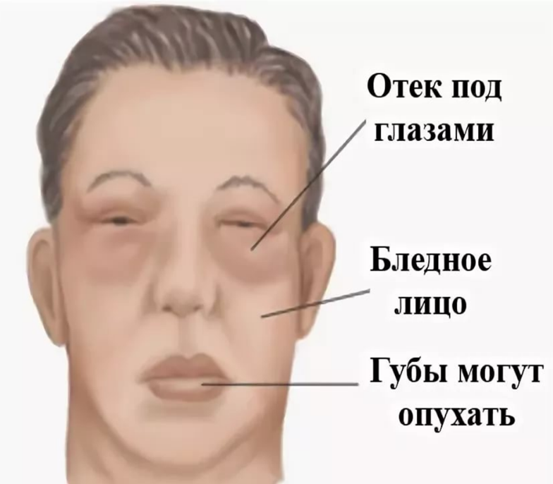 Аллергия на йоркширского терьера: симптомы, что делать?