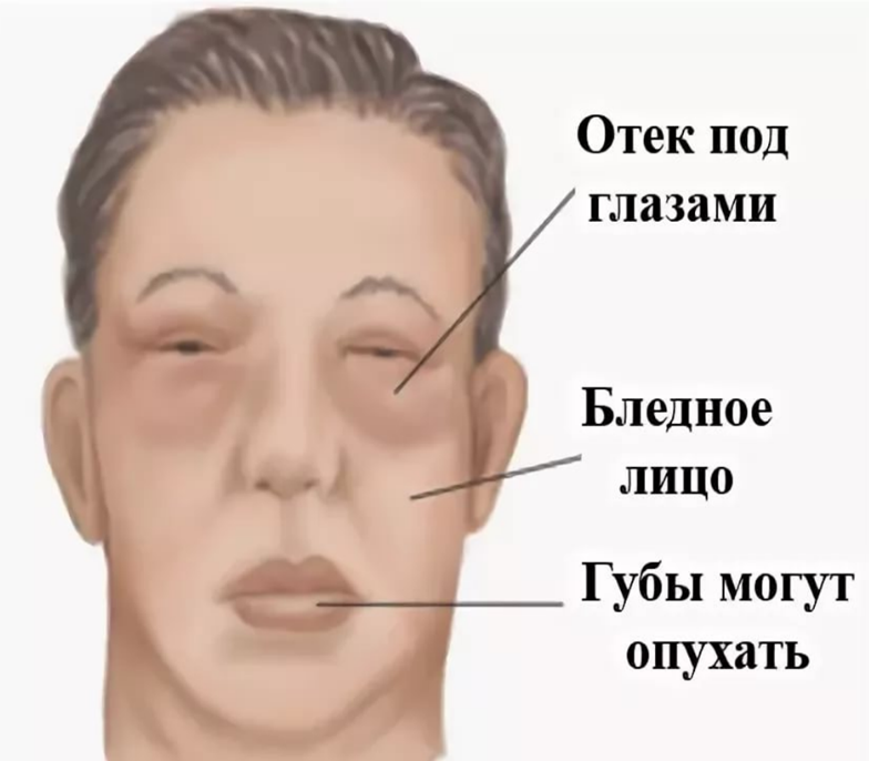 Эндокринолог рассказала, почему косметология не помогает в борьбе с отеками