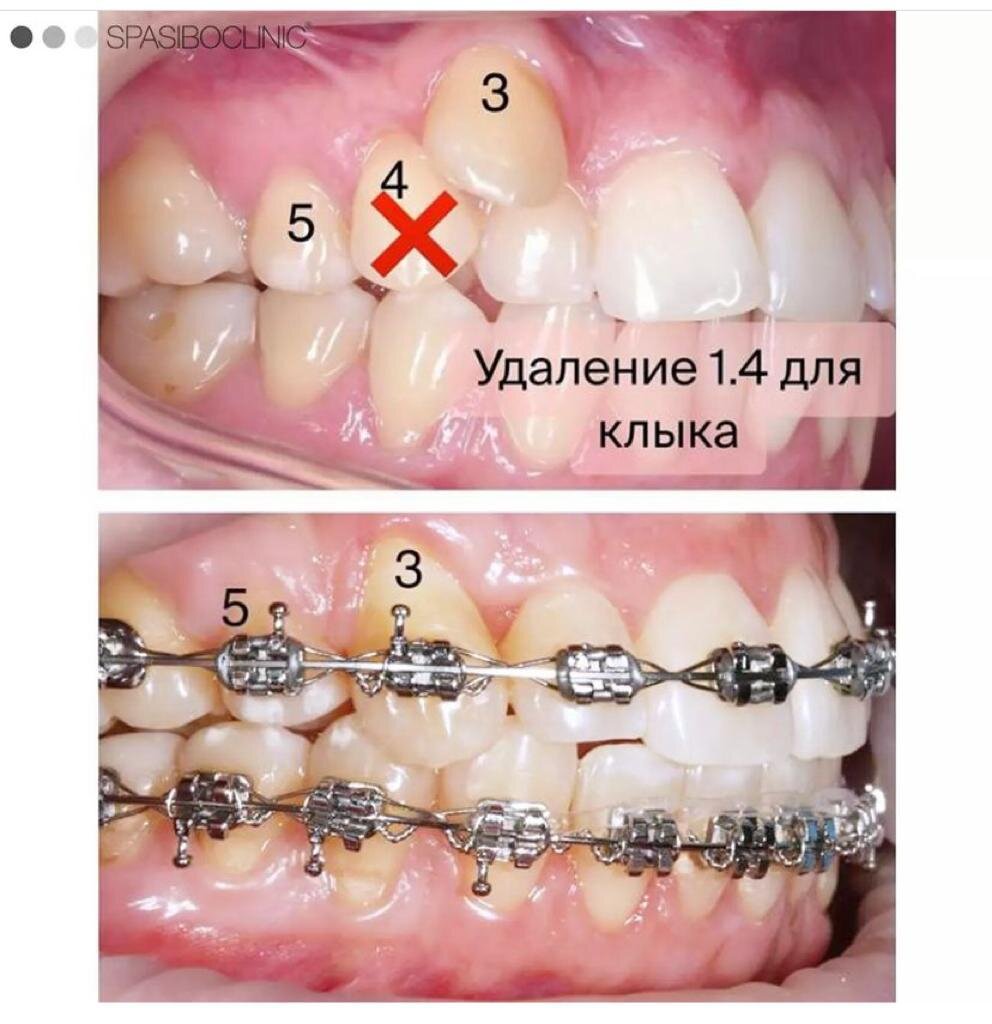 КОГДА НУЖНО УДАЛЕНИЕ? | Спасибо.Клиник | Дзен