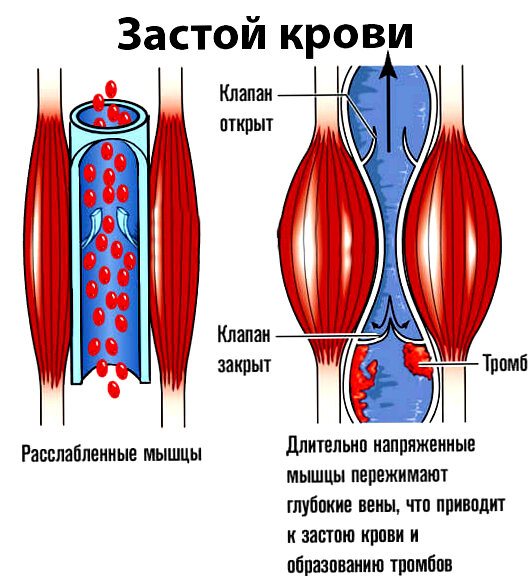 Плохо циркулирует кровь. Плохое кровообращение, застой крови. Застой крови в Малом тазу.