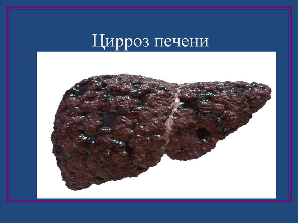 Разлагается печень. Этаноловый цирроз печени.