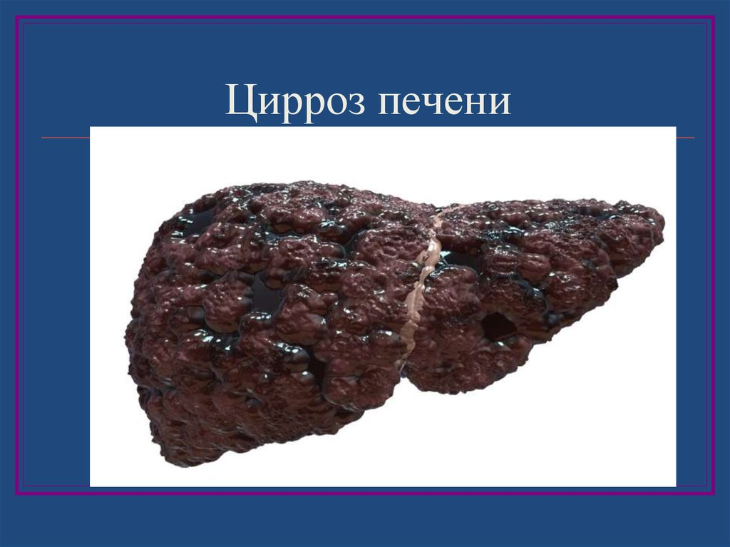 Плохая печень что делать. Этаноловый цирроз печени. Гепатитный цирроз печени.