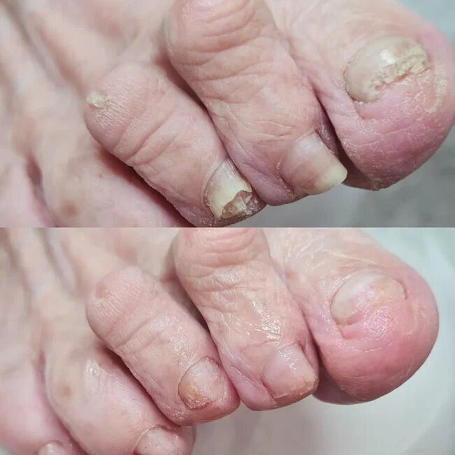 да зачистки ногтевой пластины и после