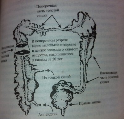 Постановка очистительной клизмы