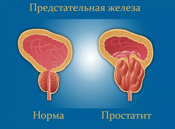 Как избавиться от хронического простатита. Методы лечения