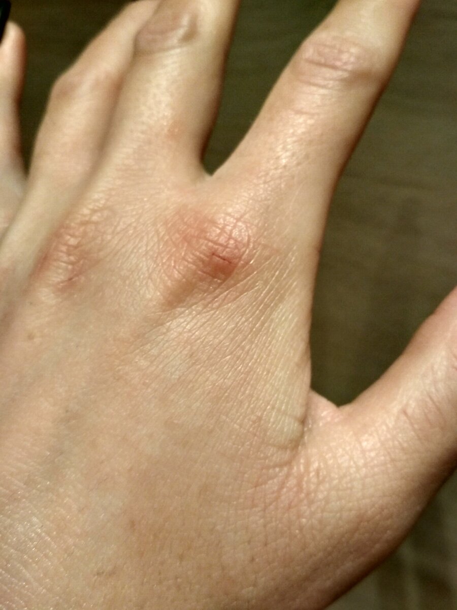 Сухости меньше, а вот трещинки не заживают