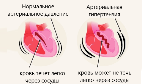 Артериальное давление меняется каждую минуту. На него влияют активность и отдых, температура тела, диета, эмоции, поза и лекарства.