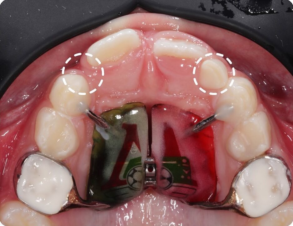 Сильный дефицит места для прорезывания боковых резцов