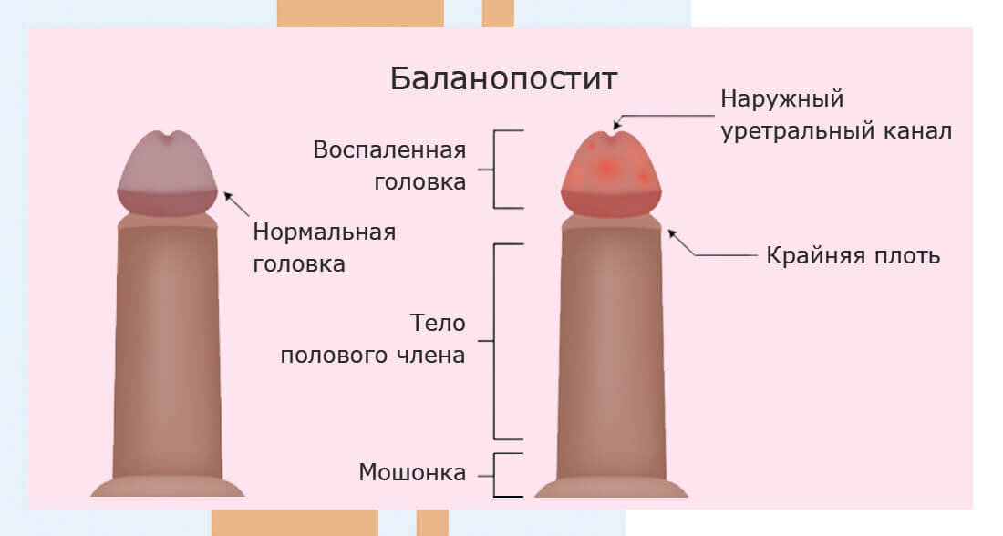 Баланопостит (воспаления крайней плоти и головки полового члена)