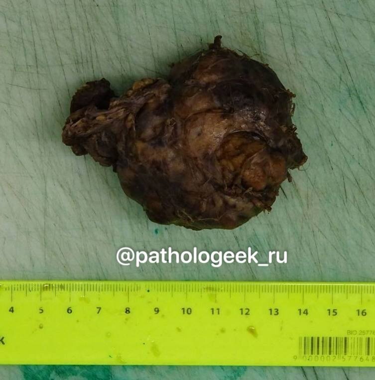 Слюнная железа с опухолью