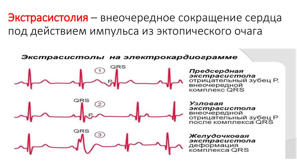 Экстрасистолия что это такое