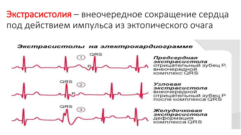 Желудочковая экстрасистолия