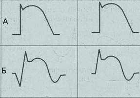 Кошачья спинка. Кот дзен. Кошка изгибается. Кошачья спинка. Инфаркт кошачья спинка на экг.