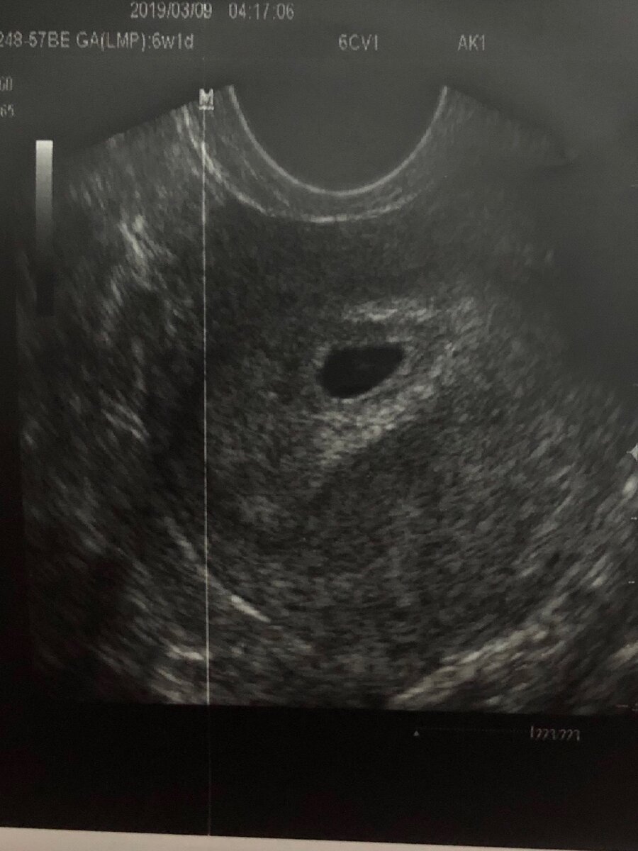 УЗИ на сроке 5 недель, видно пустое плодное яйцо без эмбриона