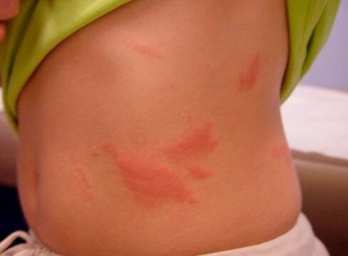 Подобные временные высыпания были у меня на животе