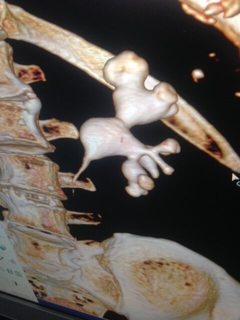 Так выглядит коралловидный камень почки на компьютерной томографии