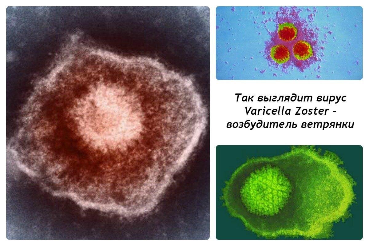 Ветрянка. Как лечить болезнь и как защититься от нее? | vsevrachizdes.ru |  Дзен