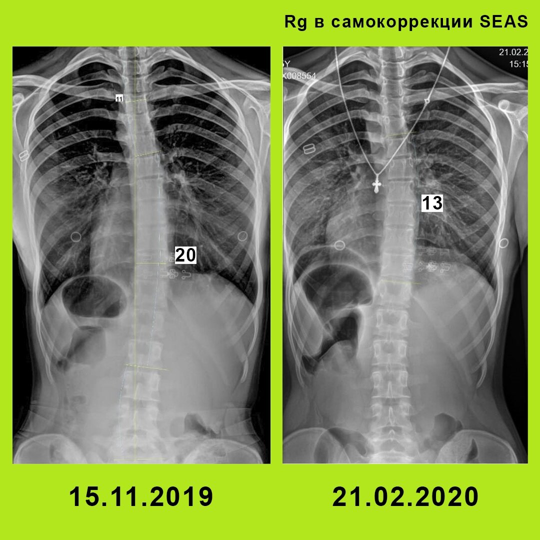 сколиоз 3 фото