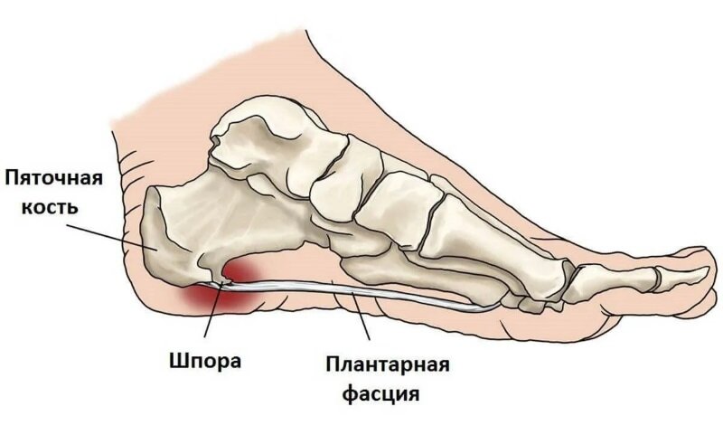 Лечение пяточной шпоры