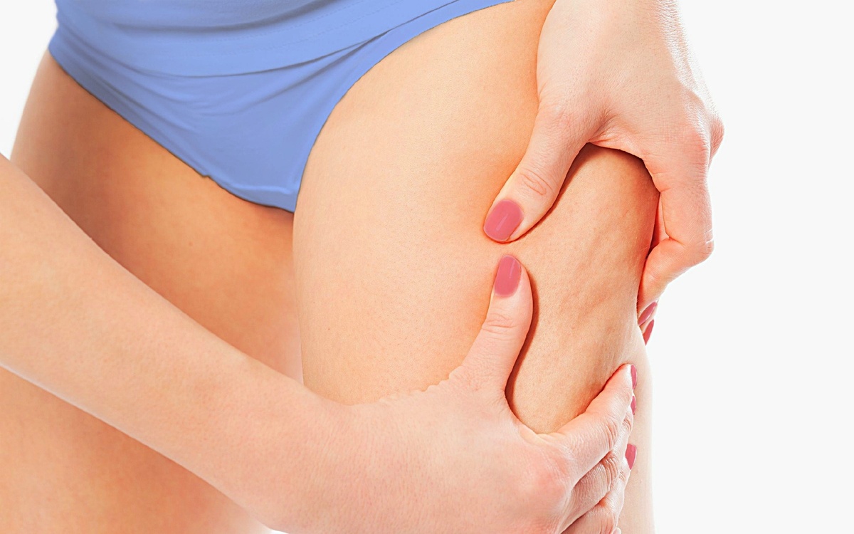 Примерно такой целлюлит был у меня, но чуть больше, чем на фото.