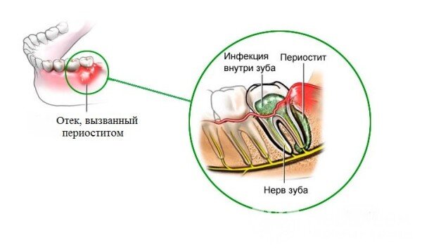 Как лечить флюс на десне у взрослого, лечение антибиотиками. Фото флюса на десне