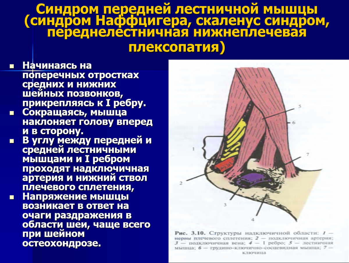 Синдром мышцы. Миофасциальный синдром передней лестничной мышцы. Передняя лестничная мышца синдром. Синдром передней лестничной мышцы синдром Наффцигера. Синдром плечичной мышцы.