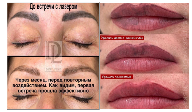 Фото до и после удаления татуада